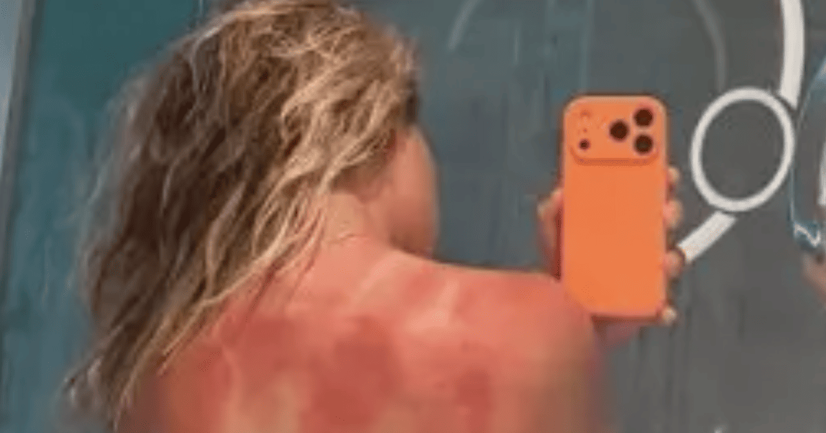 Scorching Melbourne Sun Leaves Tennis Star with Painful Tournament Souvenir